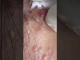 Big Cystic Acne Blackheads Extraction Blackheads & Milia, Whiteheads Removal Pimple Popping #shorts