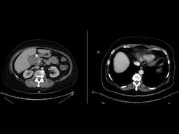 Gallstone ileus