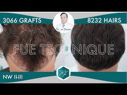 Hair Graft Technique FUE - 3066 Grafts (8232 Hairs) - Dr. Rafael de Freitas