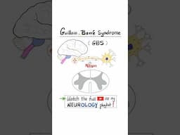 Guillain-Barré Syndrome (GBS) (acute inflammatory demyelinating polyradiculoneuropathy)…#anatomy