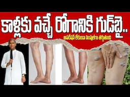 Natural Cure for Varicose Veins | కాళ్లకు వచ్చే రోగానికి గుడ్ బై | Dr Manthena Satyanarayana Raju