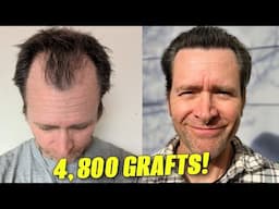 My HUGE Hair Transplant 6 Month Update | Before & After