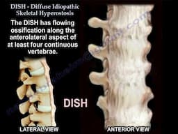 Diffuse Idiopathic Skeletal Hyperostosis (DISH) and the Key Differences from Ankylosing Spondylitis