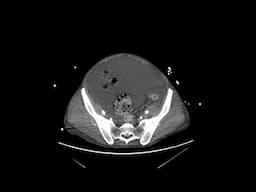 metastatic pancreatic cancer