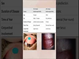 Atopic keratoconjunctivitis V/s Vernal Keratoconjunctivitis  #opthalmology