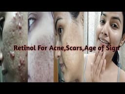 Retinol/ Tretinoin For Acne, Scars,Age of Sign || कब, कितना, कैसे पूरी जानकारी