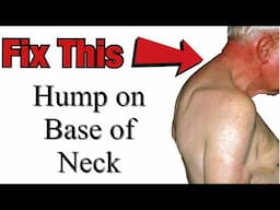 How To Reduce The Hump On My Back- Ask A Physio