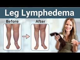 Leg Lymphedema Treatment - How to Reduce Swelling