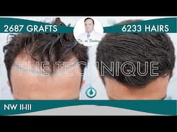 Hair Graft Technique FUE - 2687 Grafts (6233 Hairs) - Dr. Rafael de Freitas