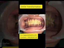 Smile Transformation for Yellow Coloured Teeth #shorts #ytshorts #viralshorts #yellowteety