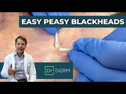 Easy Peasy Blackheads | Dr. Derm