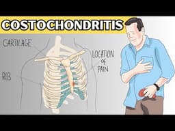 Costochondritis - Causes, Signs And Symptoms, Diagnosis, And Treatment