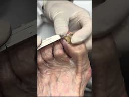 Extreme Nail Cutting: Sensitive and Tricky Nails!  #satisfyingshorts #nails #foot