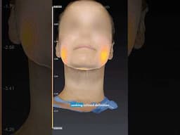 Buccal Fat Removal vs. Buccal Fat Pad Reduction #facialplasticsurgery #plasticsurgery