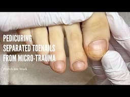 Pedicuring separated toenails due to micro trauma