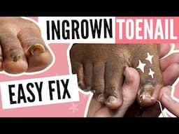 Step by Step Ingrown Toenail Pedicure Transformation