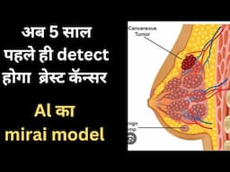 अब 5 साल पहले पता चलेगा ब्रेस्ट कॅन्सर||brest cancer symptoms||brest cancer kaise hota hai