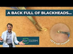 A Back Full of Blackheads! | Dr. Derm