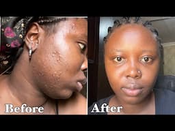 How i got rid of ACNE AND HYPERPIGMENTATION FAST! Skincare routine for acne scars, dark spots