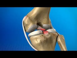 Pcl  ligament injury examination and clinical test