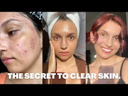 HOW I CLEARED MY ADULT ACNE ✨ Skin Care Tips For Glowy Skin, Texture & Hyperpigmentation