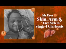 A Patient's Journey: My Eyes, Skin, Arm and Face Sick in Stage 4 Cirrhosis.