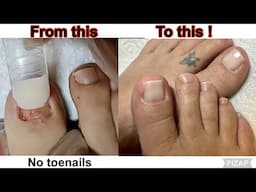 POLYGEL & Dual Forms On Toes with NO NAILS- Get a Quick Natural Look !