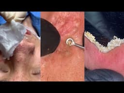 11 Minutes Of Top ASMR Pimple Popping Video