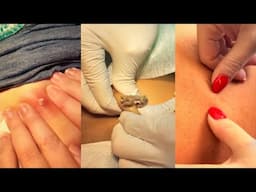 12 Minutes Of Top ASMR Pimple Popping Video