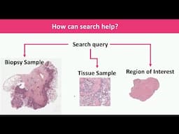 AI, Digital Pathology and Observer Variability: From Image Search to Building Diagnostic Consensus