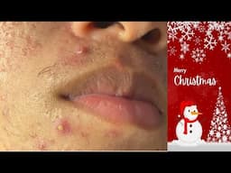 Staff of Huong Da Nang_ Purulent acne PArt 1#720     Merry Christmas 2024