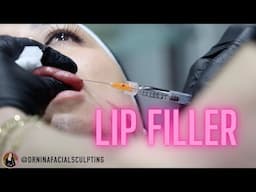 Enhancing Naturally Plump Lips | Dr Nina Bal's Hydrating Lip Filler Treatment 💕