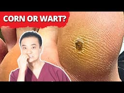 Corn or Wart?? MUST WATCH Satisfying Removal!