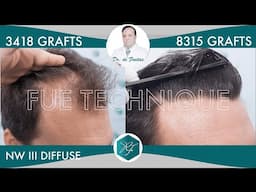 Hair Graft Technique FUE Grafts 3418 (8315 Hairs)