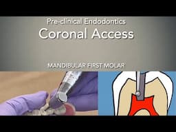 Coronal Access (Mandibular First Molar)