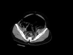 Sigmoid Volvulus