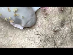 Big Cystic Acne Blackheads Extraction Blackheads & Milia, Whiteheads Removal Pimple Popping