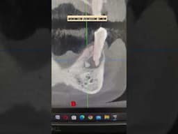 #DENTAL CYST / TUMOUR