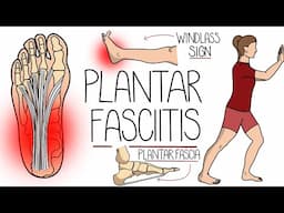 Plantar Fasciitis Explained Clearly (Including Treatment Options!)