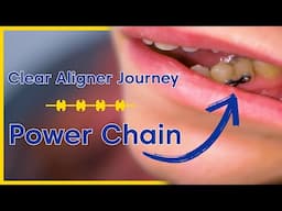 Power Chains: The Clear Aligner Secret You Didn't Know About