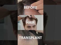 This is how a Hair Transplant transformation looks #vincihairclinic #hairloss #shorts