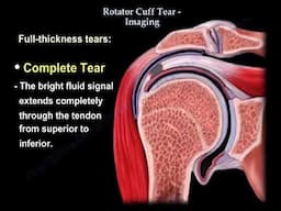 Rotator Cuff tear  Imaging