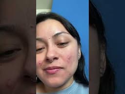 PIMPLE POPPING #acneproneskin #pimplepopping #pimple #acne #acnetreatment