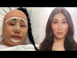 My Facial Feminization Surgery Story | Gia Gunn