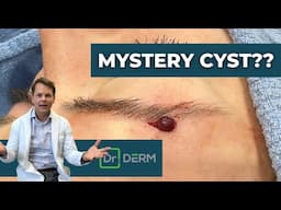 Mystery Cyst?? | Dr. Derm