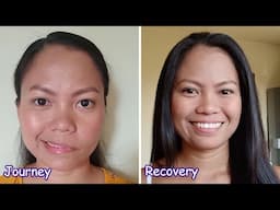 My Bell's Palsy journey to recovery | Facial Paralysis