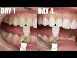 SUPER WHITE TEETH in 4 DAYS At Home! Dentist Shows Daily Results Better  Than a Dentist Office.