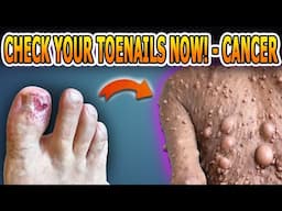 Take a look at your toenails right now! If you have these symptoms, it could be a sign of cancer!!