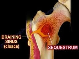 Osteomyelitis: Bone Infection Causes, Symptoms, and Treatment