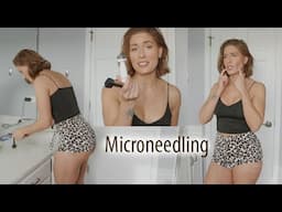 Microneedling - How It's Changed my skin and Tips